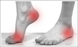neuropathy